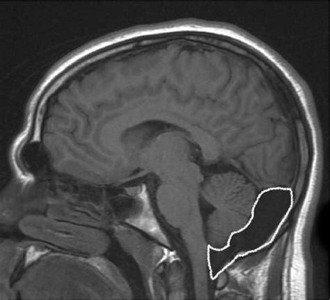 mega cisterna magna versus arachnoid cyst